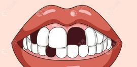 缺牙的三種修復(fù)方式了解下:活動(dòng)義齒、固定假牙、種植牙