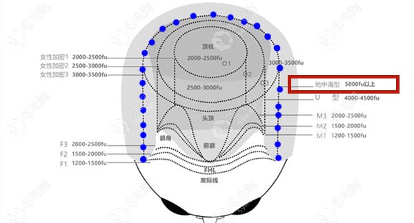 植发1000/2000/3000/5000/6000株是多大面积?这有植发面积图可参考