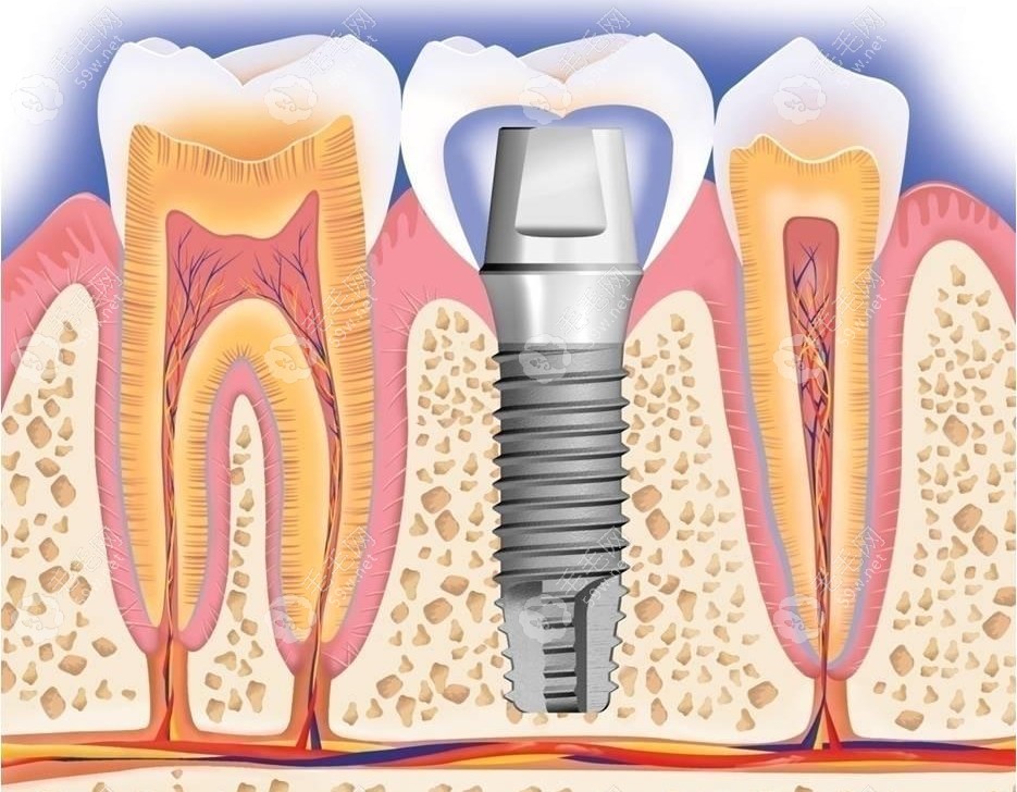 种植牙结构示意图