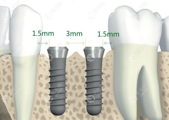 种植体与种植体之间的距离