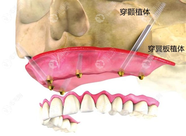 穿颧穿翼种植方式