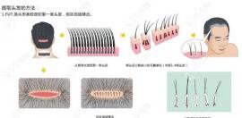植发7/10/15元一个毛囊单位贵吗？可参考各类植发技术单价