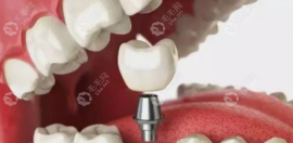 即刻种植牙好还是延期3个月后种植好,两者的优缺点各是什么