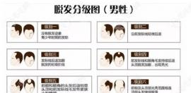 植發(fā)數(shù)量如何確定?看完脫發(fā)等級和植發(fā)數(shù)量示意圖就明白了