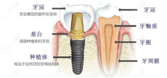 种植体使用量大，价格低