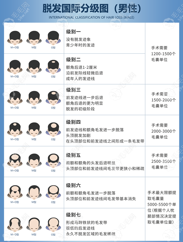 头顶脱发分级图m.59w.net