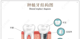 上门牙为什么不建议种植?莫非上门牙种植难度/风险大是真的