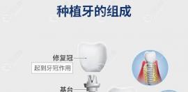 以色列雅定种植体系统介绍:含Adin种植体型号/材质/质保/价格