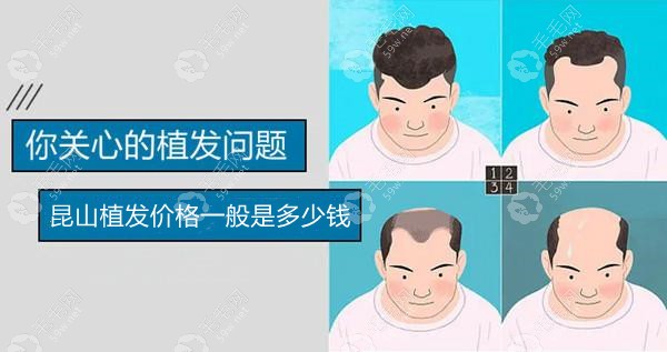 昆山植发价格一般是多少?能不能再说下5000个毛囊植发的价格