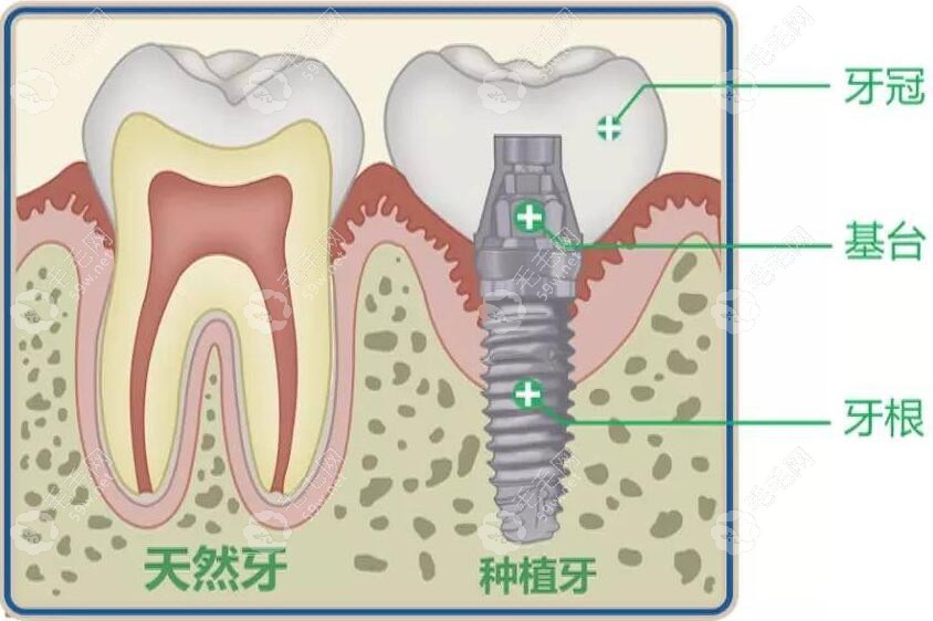 种植体材质四级钛、五级纯钛和钛锆合金的区别