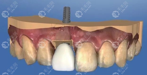 种植牙方案模拟图