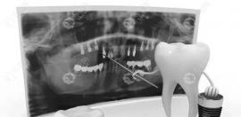 分析:国产种植牙的质量可靠吗,和进口种植牙质量差别大不