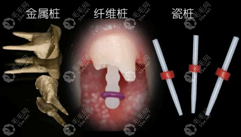 牙齿打桩用金属好还是纤维好?从纤维桩和金属桩的区别来说