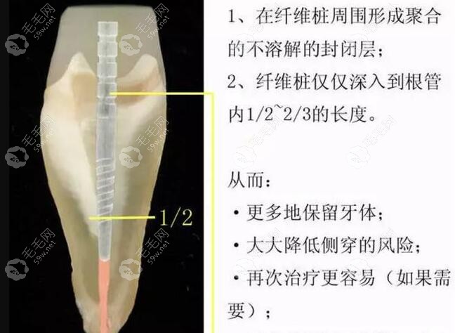 牙齿打桩做冠时，选用纤维桩比金属桩好