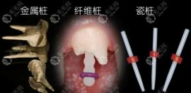 牙齿打桩用金属好还是纤维好?从纤维桩和金属桩的区别来说
