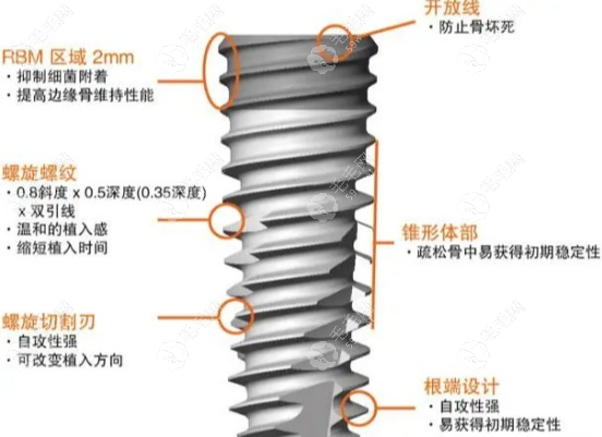 瑞典诺贝尔种植体优势及特点