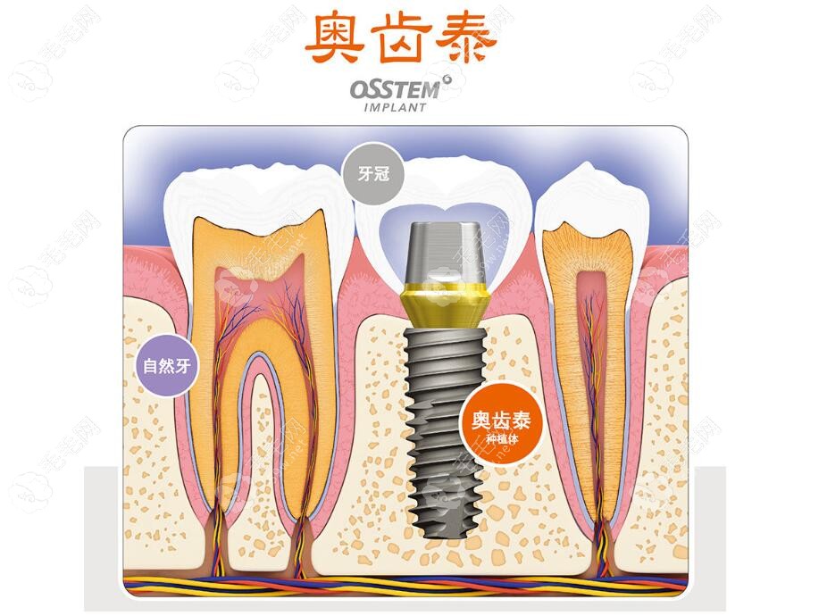 韩国奥齿泰种植牙实图