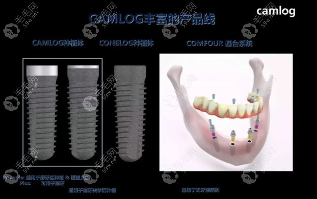 德国种植体的价格及特点