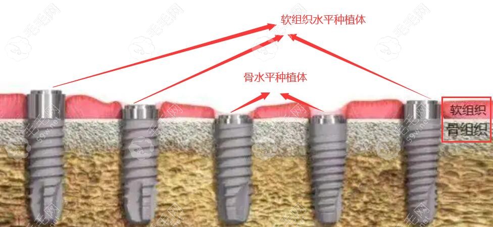 瑞士士卓曼iti软组织水平和骨水平区别:价格/优缺点对比