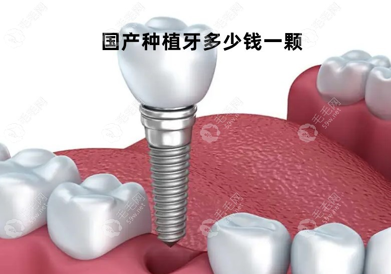 国产种植牙多少钱一颗2022价格表,含创英/威高/百康特等价格