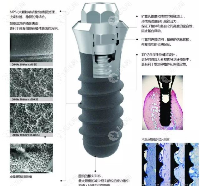 创英种植体技术特点