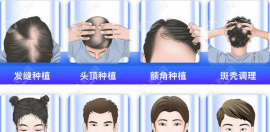 碧莲盛植发际线大概需要多少钱?以种植1000/1500/2000单位为例