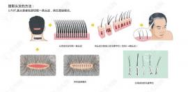 金華植發(fā)價(jià)格明細(xì)一覽表,看金華好的植發(fā)醫(yī)院種頭發(fā)多少錢