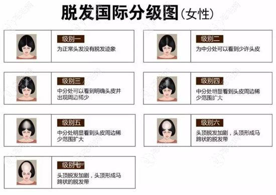 女生版的脱发1-7级程度图片