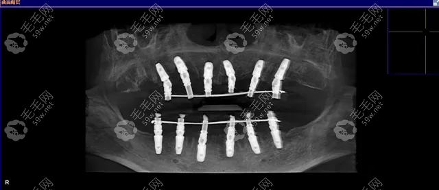 all-on-6全口种植牙