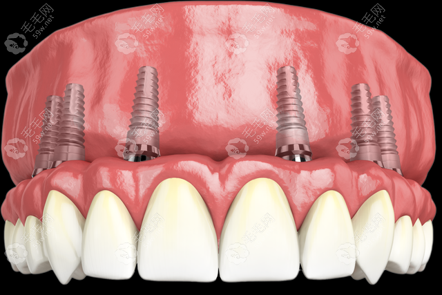 一次性种植6颗牙危险吗