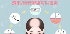  资阳/雅安哪里可以植发?找种头发医院可参考恒美/首瑞