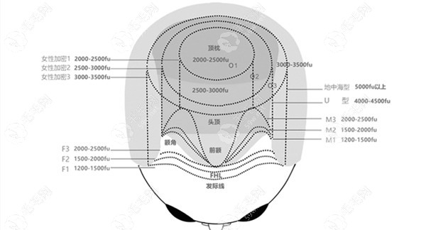 无锡头顶植发价格是：1万元起
