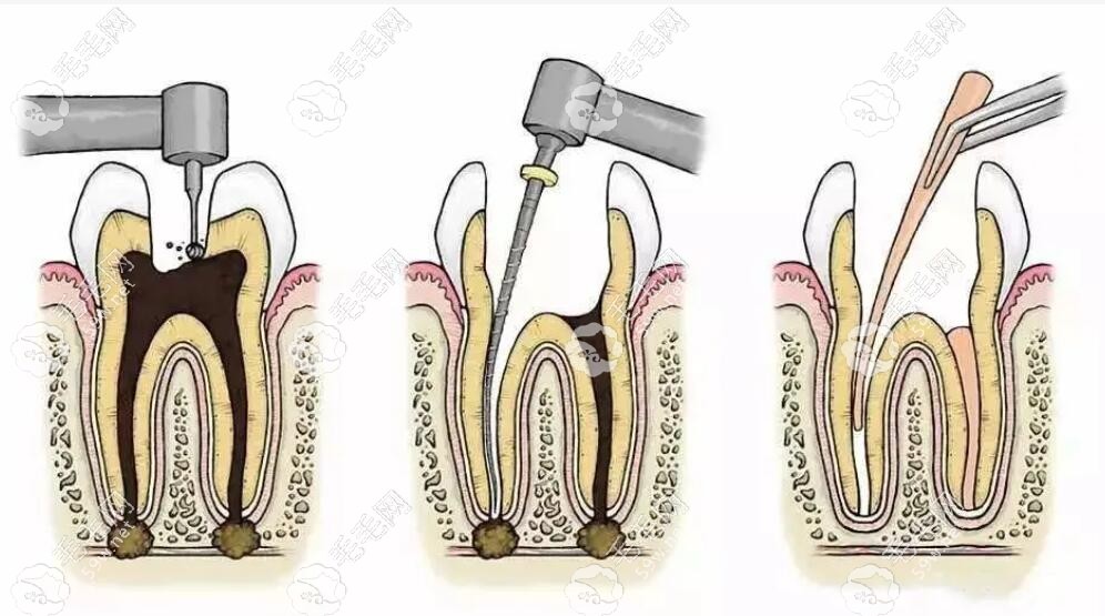 根管治疗的过程