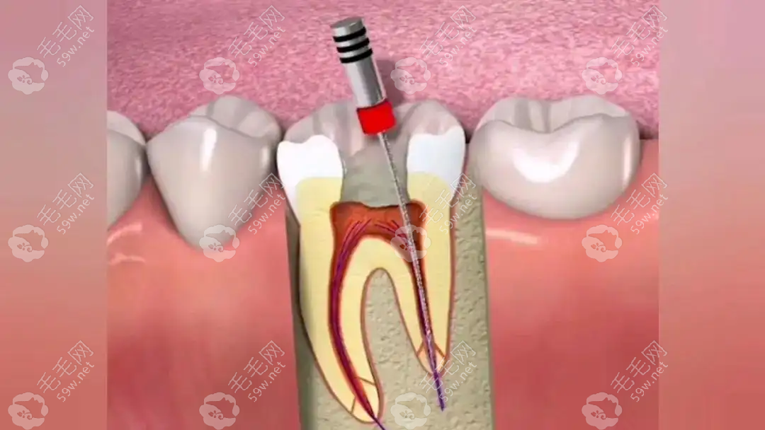 千万不要随便去除牙神经，我杀牙神经两天后悔了