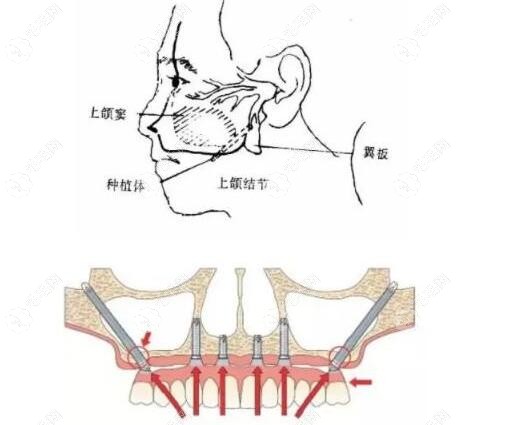 分享穿颧穿翼板种植牙技术适应症及术后有什么风险