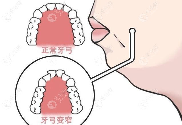 凸嘴改善情况