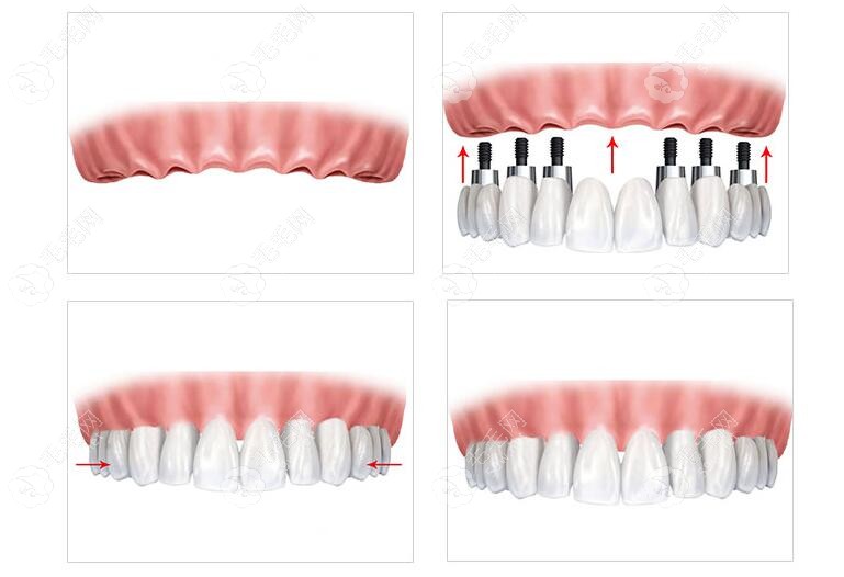 全口种植牙形式