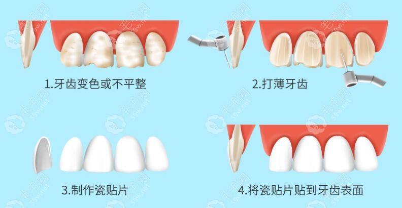 瓷贴面佩戴过程m.59w.net