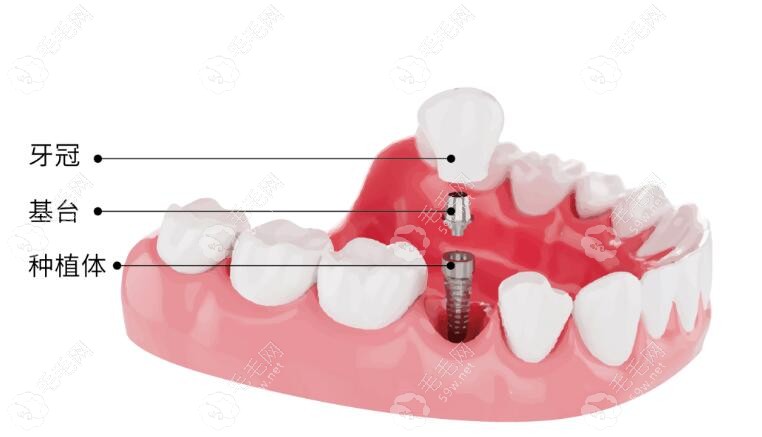 单颗种植牙卡通图