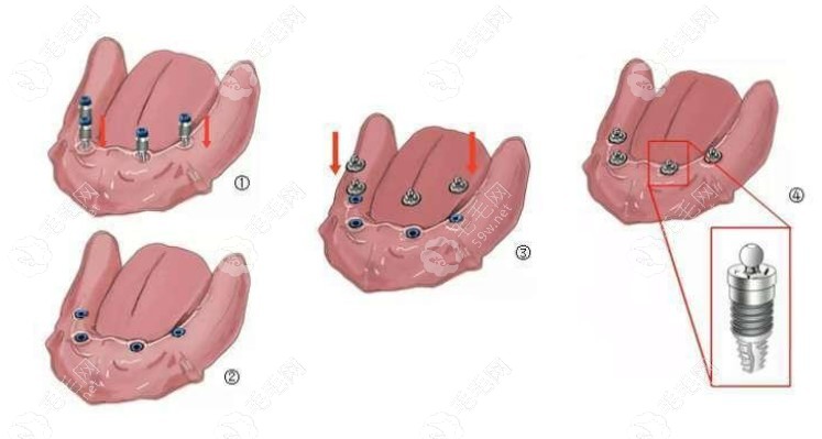 半固定全口种植牙步骤图