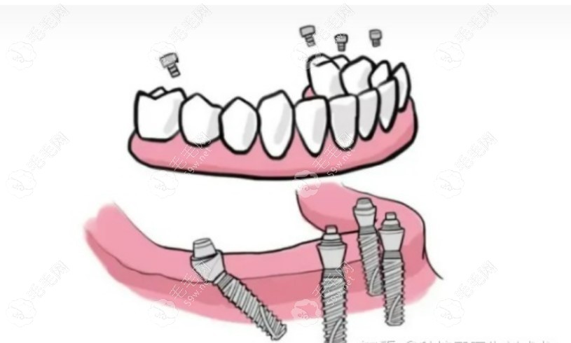 allon4种植牙演示图