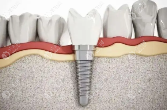 国产种植牙质量不输于韩国种植牙
