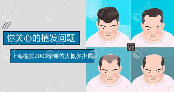 上海植发2000个单位大概多少钱