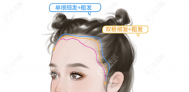 成都青羊区发际线植发医院哪家好?前3正规好机构丝缘|恒美..