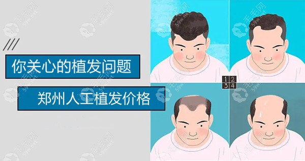 郑州人工植发一个单位:10-60元左右,人工植发一次价格8千元起