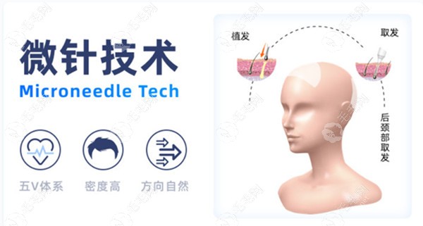 北京做微针植发比较好的医院排名及价格曝光,植发朋友必看