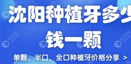 沈阳种植牙多少钱一颗2025?单颗/半口/全口种植价格费用公布