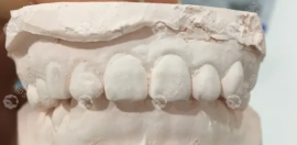 骨性深覆合千万不要矫正?那骨性深覆合不做正颌手术有救吗