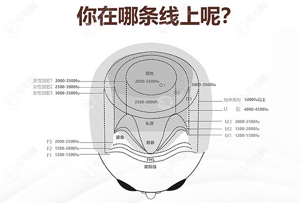 成都金牛区植发价格多少?价格表上头顶大/小面积植发费用是