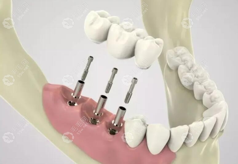 多颗种植体的种植方式